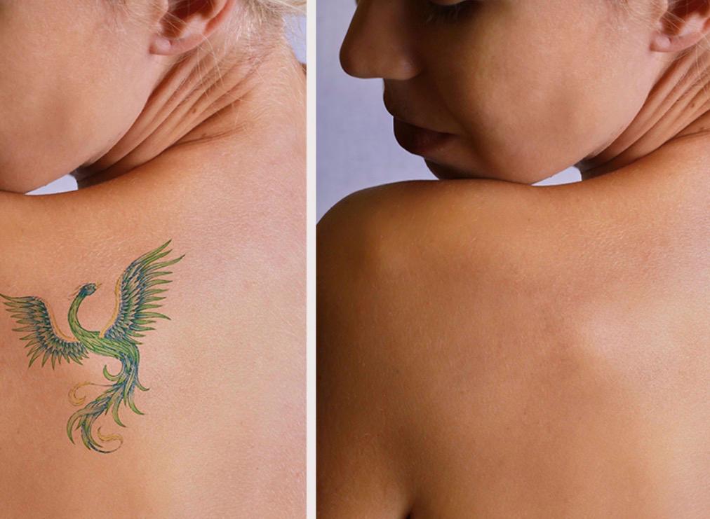 Antes y despu&eacute;s de eliminaci&oacute;n de tatuajes con l&aacute;ser